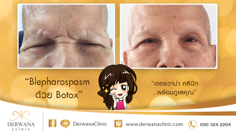 เดอร์วาน่า คลินิก DERWANA Clinic | Blepharospasm ด้วย Botox