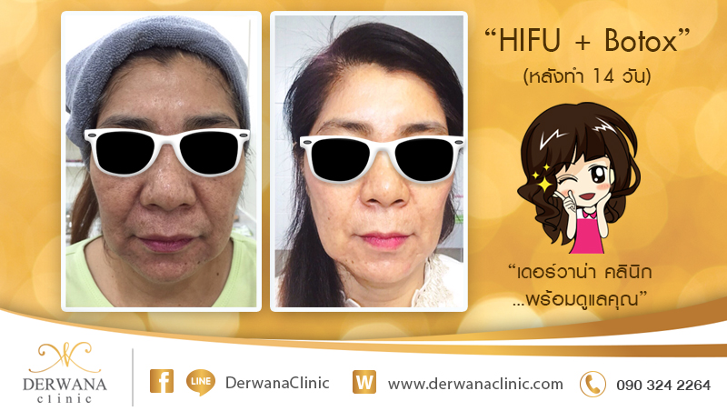 เดอร์วาน่า คลินิก DERWANA Clinic | HIFU+Botox
