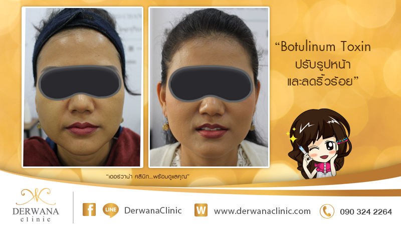 เดอร์วาน่า คลินิก DERWANA Clinic | Botulinum Toxin