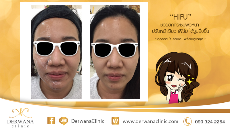 เดอร์วาน่า คลินิก DERWANA Clinic | HIFU